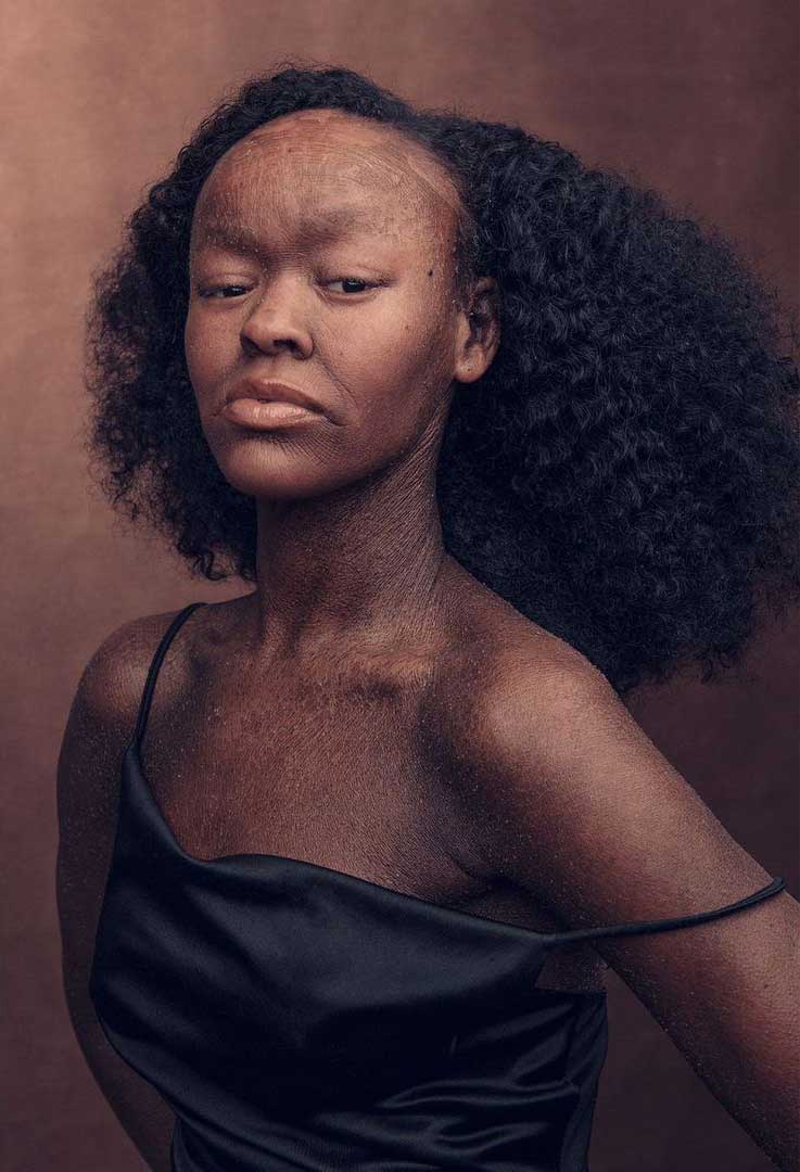 Jeyźa Kaelani, young woman with skin condition